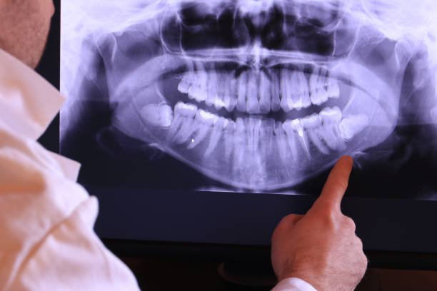 Best Emergency Root Canal Treatment in Belle Isle, FL