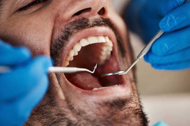 Best Emergency Treatment for Dental Infections or Abscesses in Belle Isle, FL