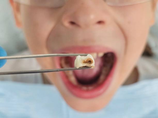 Best Emergency Tooth Extraction in Belle Isle, FL
